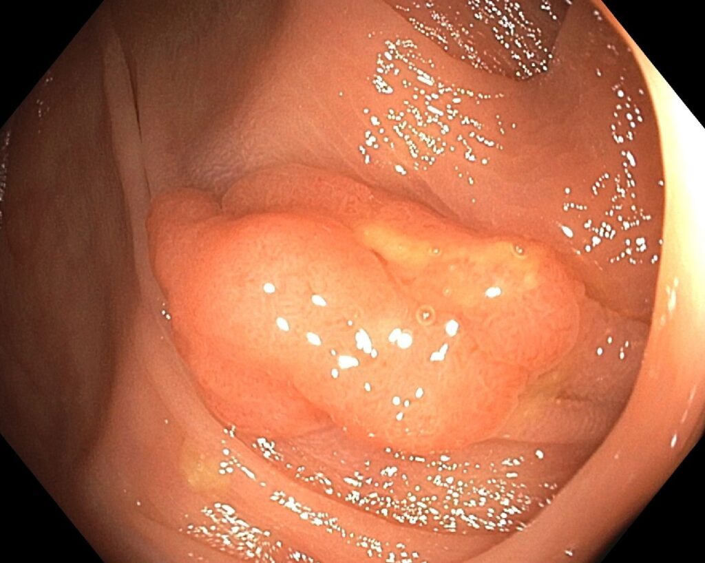 Polyp in colon