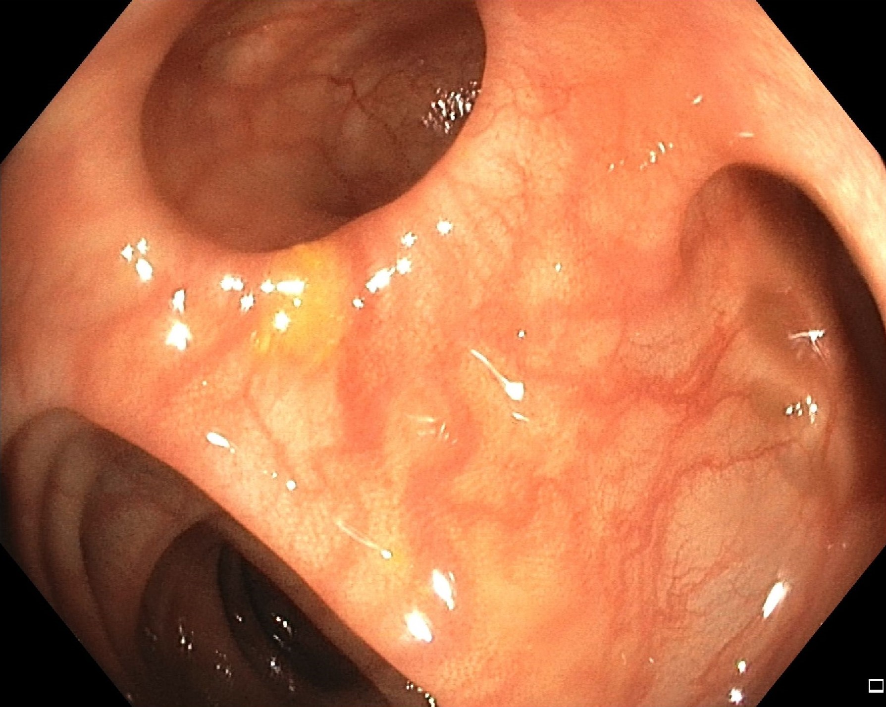 Endoscopic image of diverticulosis