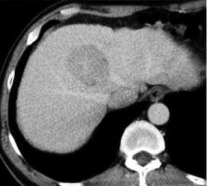 Hepatocellular carcinoma of the liver on CT scan