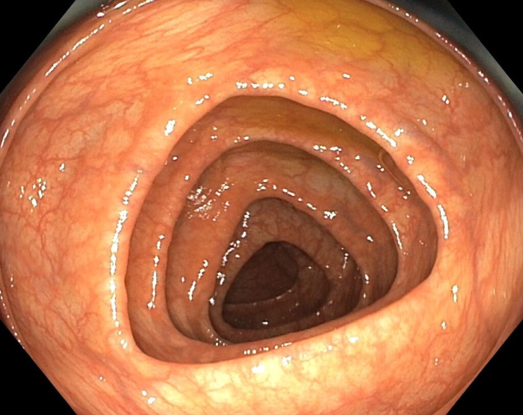 Endoscopic image of a healthy transverse colon