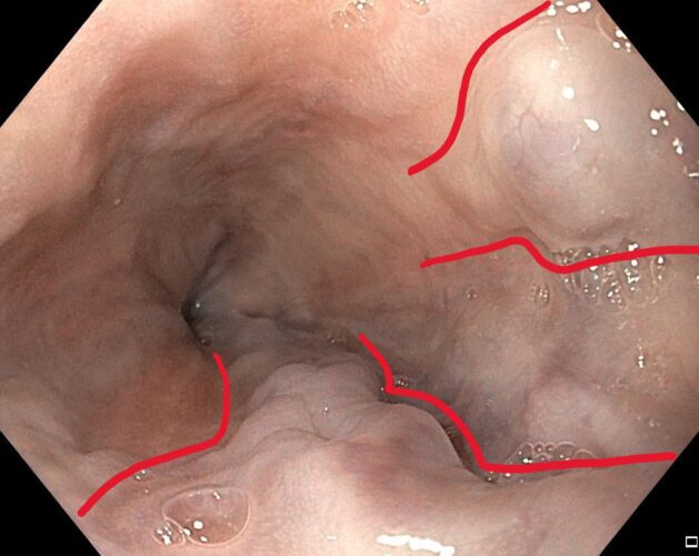 esophageal varices, endoscopic view