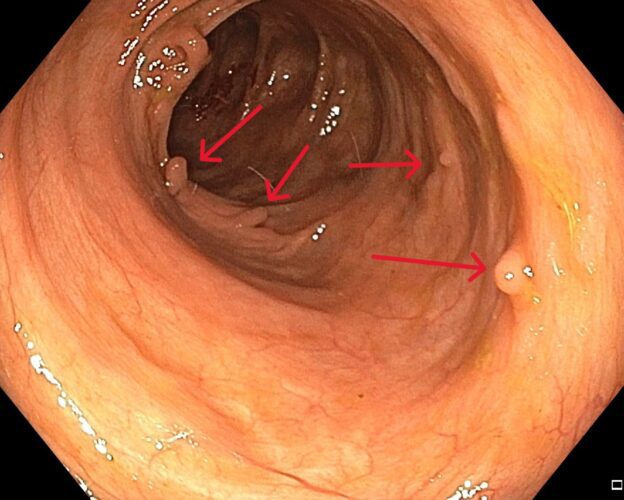 endoscopy pseudopolyps