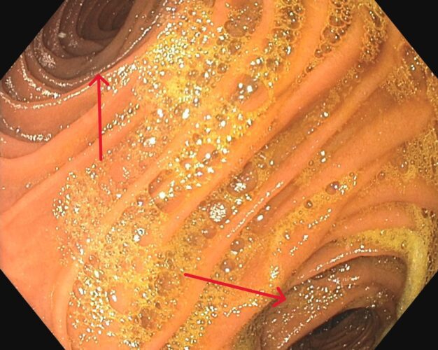 roux-en-y endoscopy