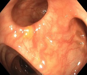 Endoscopic image of diverticulosis