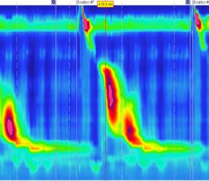 Esophageal manometry study